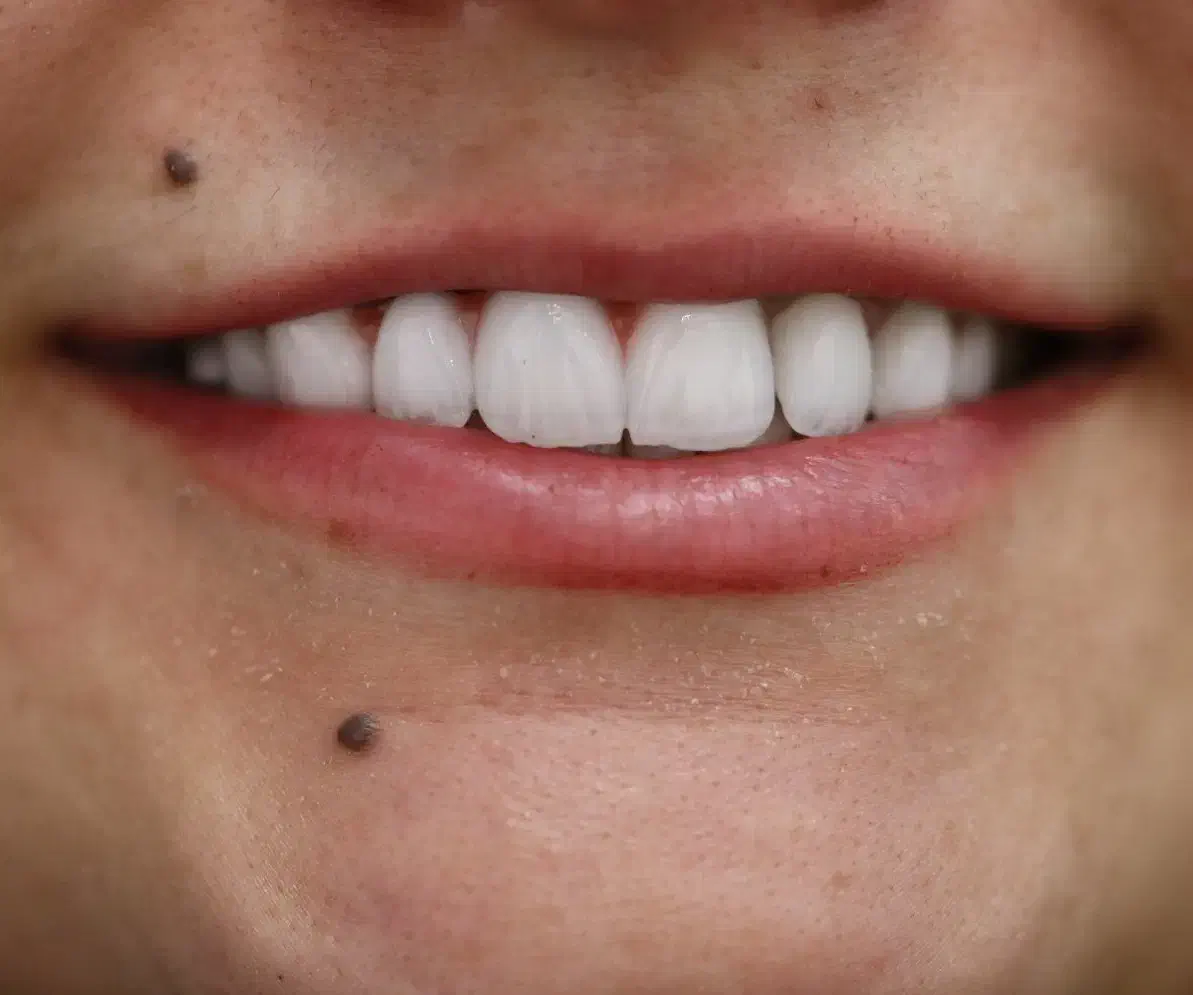 دندانپزشکی اقساطی بدون پیش پرداخت ایمپلنت کامپوزیت|خدمات آرایشگری و زیبایی|خرم‌آباد, |دیوار