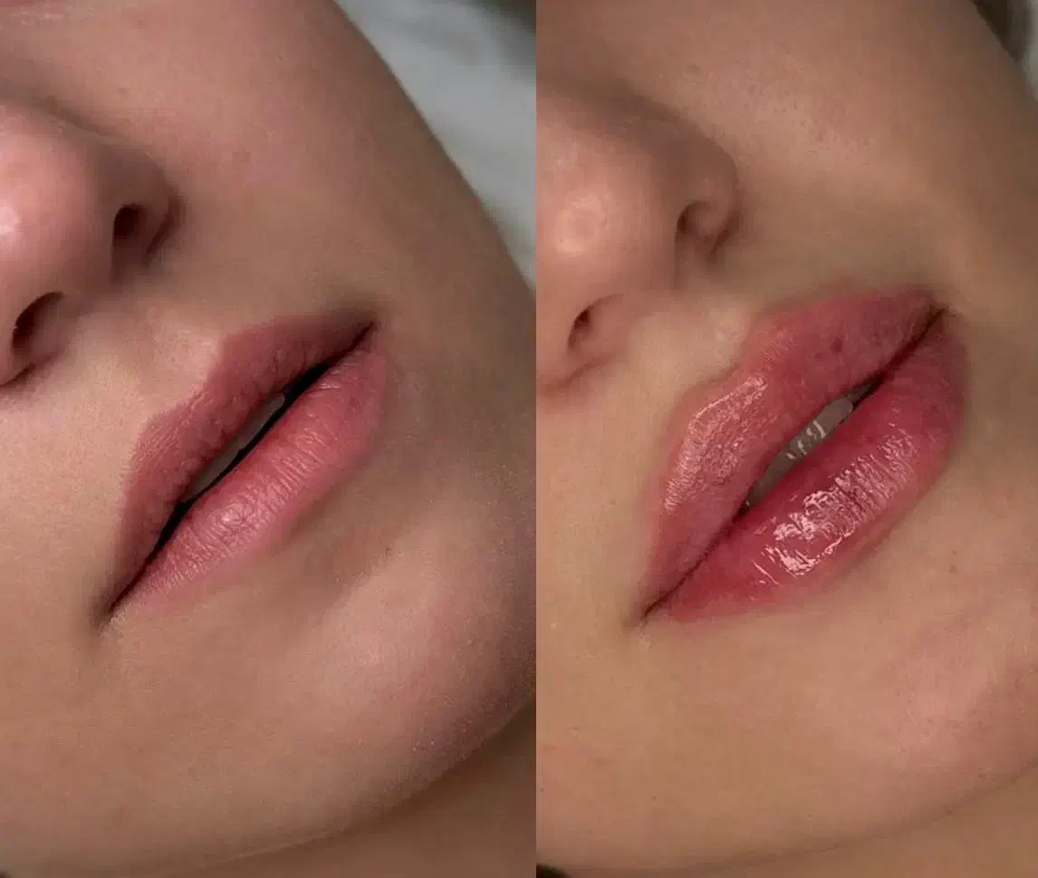 تخفیف ژل لب و بوتاکس فیلر مزو دکتر کاظمی|خدمات آرایشگری و زیبایی|مشهد, کوثر|دیوار