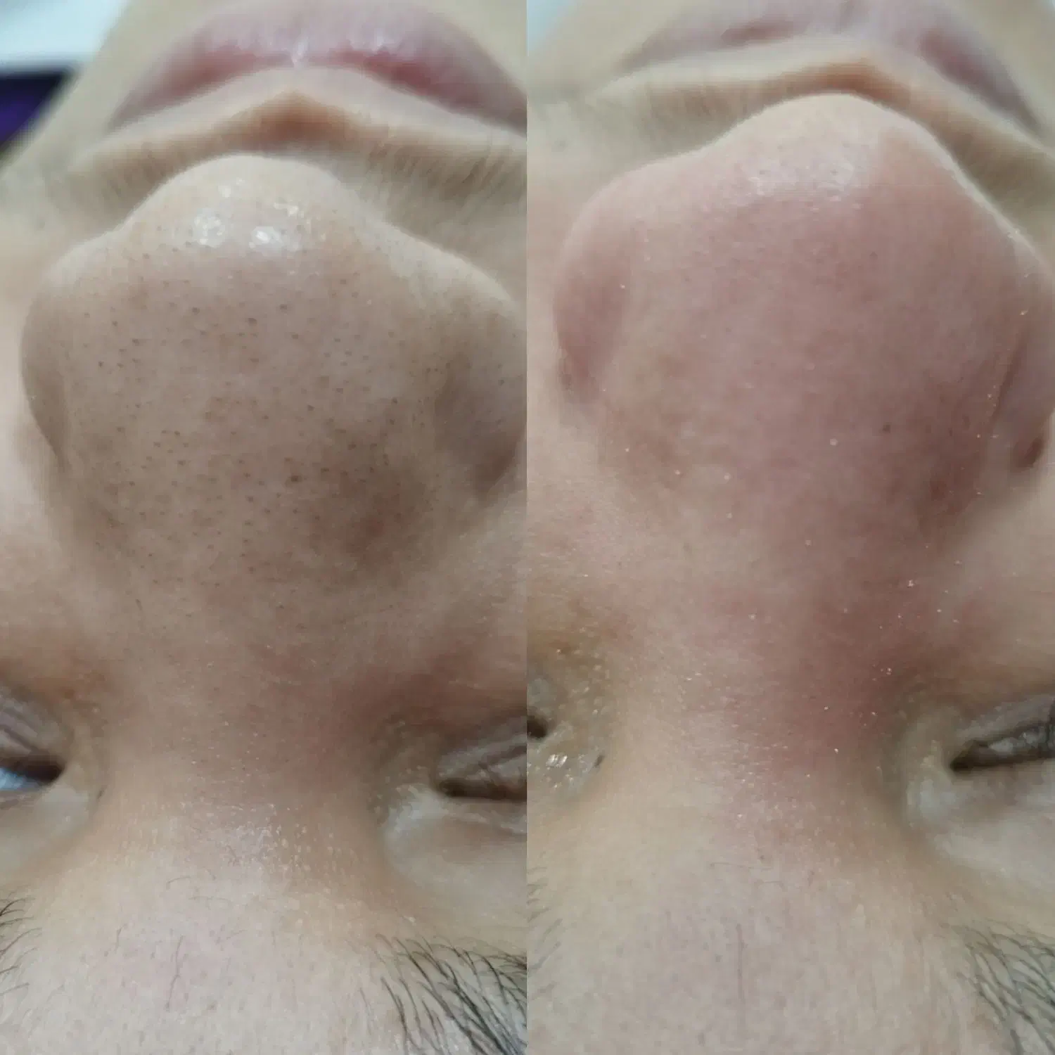 فیشیال تخصصی وپاکسازی پوست|خدمات آرایشگری و زیبایی|بندر کنگان, |دیوار