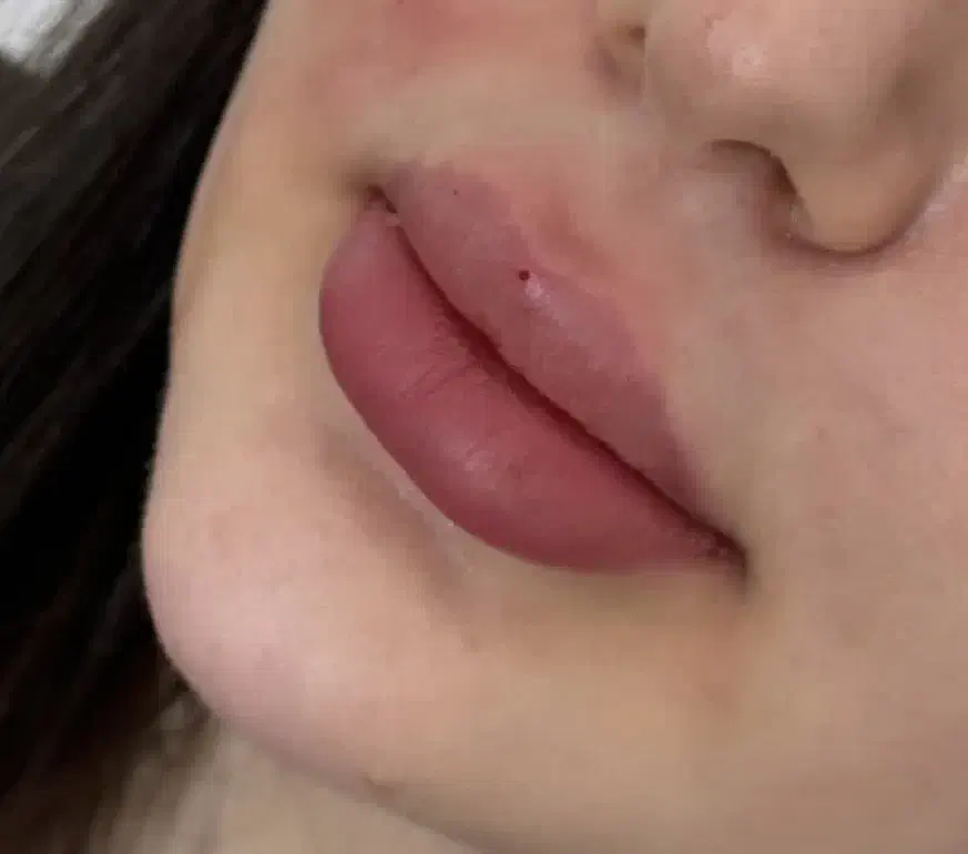 تزریق تخصصی ژل و بوتاکس زیر نظر متخصصین مجرب|خدمات آرایشگری و زیبایی|کرمانشاه, |دیوار