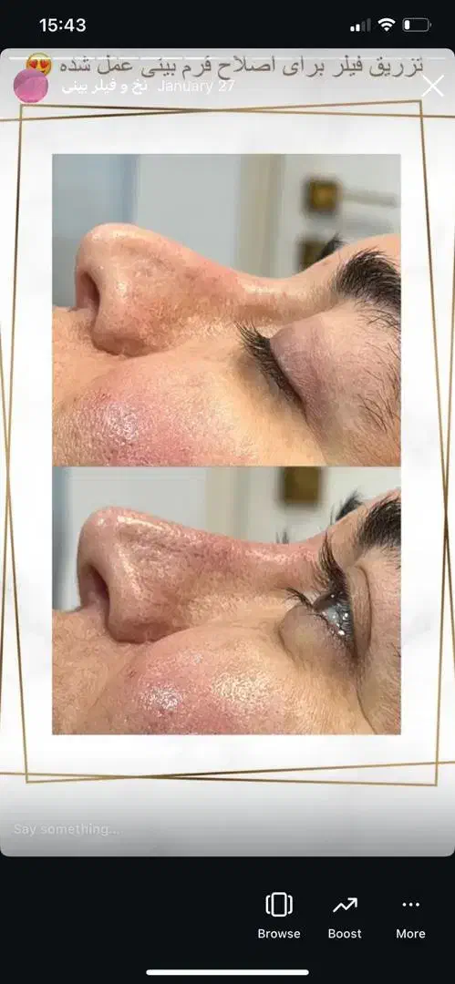 بلفاروپلاستی ۴۵۰۰/غبغب۴۵۰۰/کاشت ابرو|خدمات آرایشگری و زیبایی|ری, دیلمان|دیوار