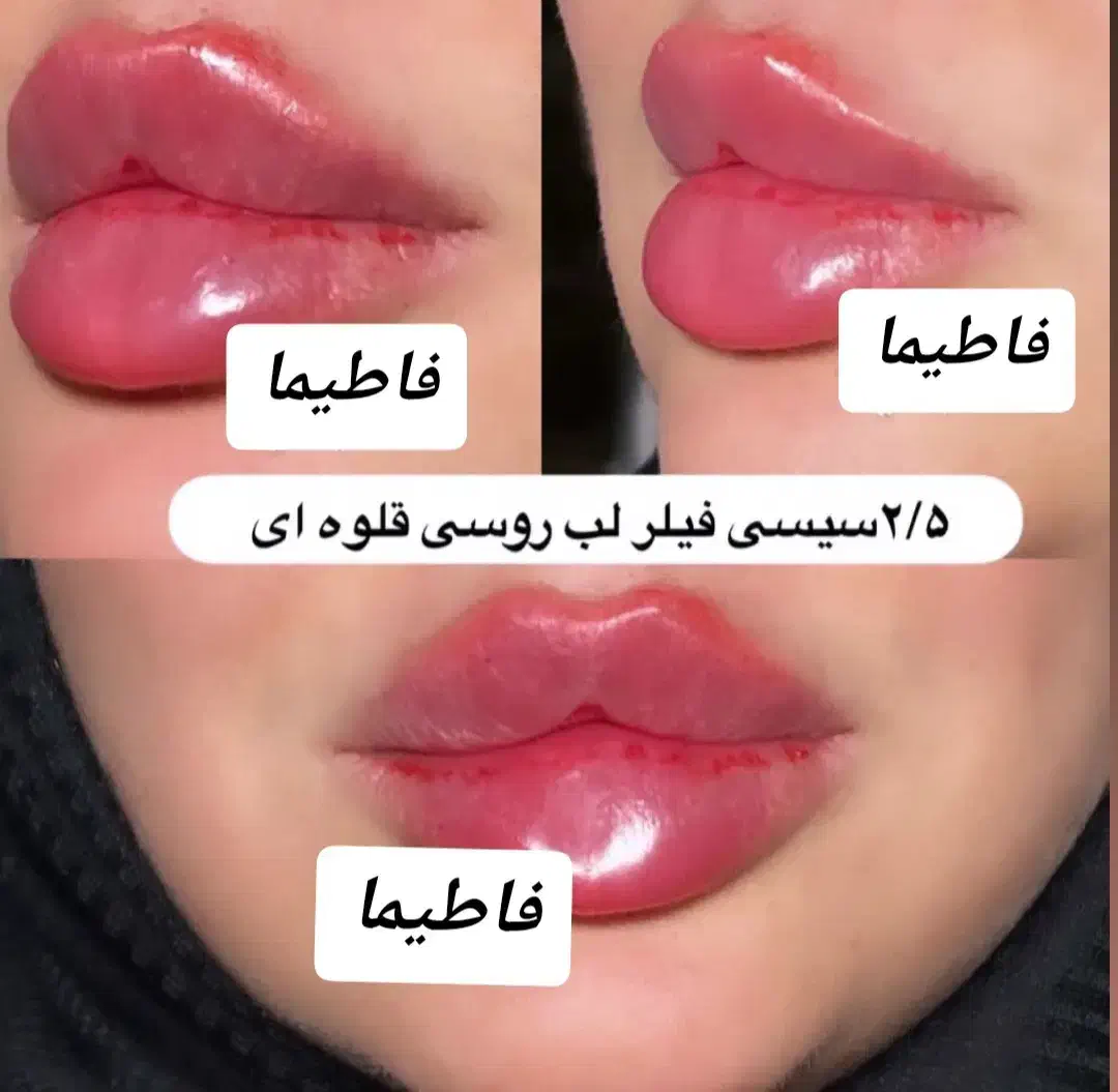 تزریق ژل و بوتاکس|آرایشگاه و سالن‌های زیبایی|ری, دولت‌آباد|دیوار