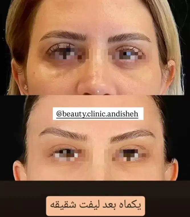 جراحی زیبایی بلفاروپلاستی،مینی لیفت صورت|خدمات آرایشگری و زیبایی|اندیشه, اندیشه فاز ۱|دیوار