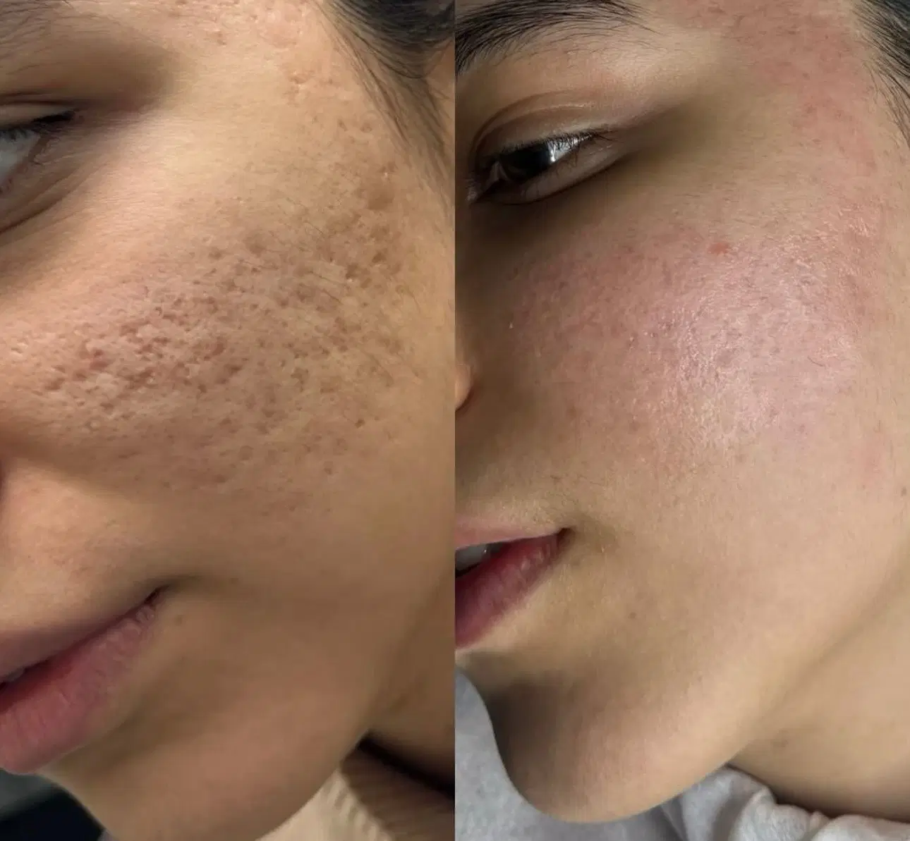 خداحافظی با جای جوش و تیرگی|خدمات زیبایی و سلامت|تبریز, |دیوار