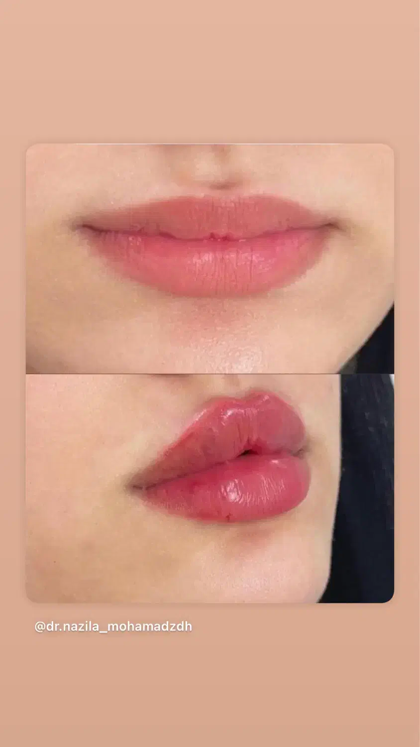 فیلر لب ۱/۶۰۰/تاپایان این هفته|خدمات آرایشگری و زیبایی|رشت, کوی حسینی|دیوار