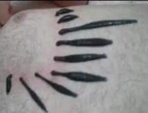 حجامت ،فصدوزالو،سم زدا ویونیزاسیون ماساژ درمانی|خدمات آرایشگری و زیبایی|سنندج, |دیوار