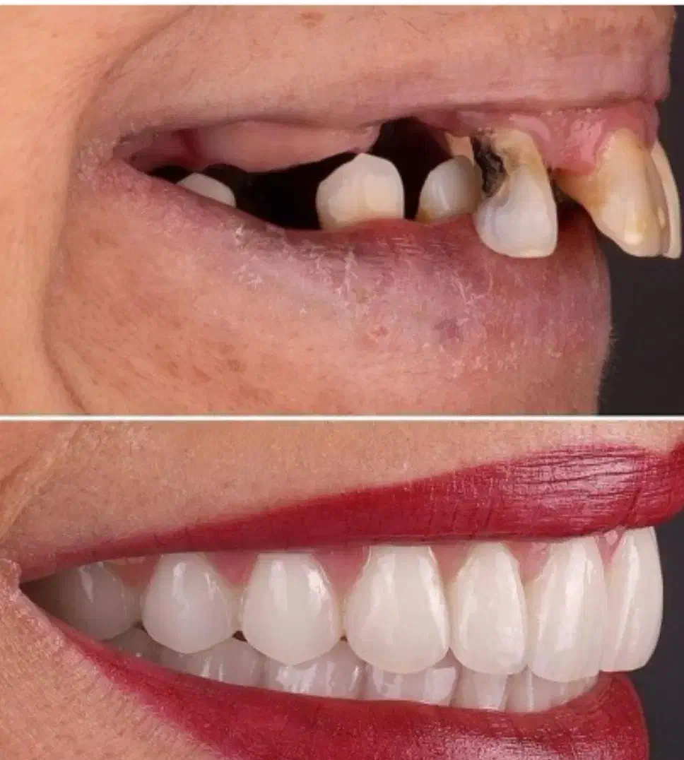 دندانپزشکی،ایمپلنت، اوردنچر|خدمات آرایشگری و زیبایی|مرند, |دیوار