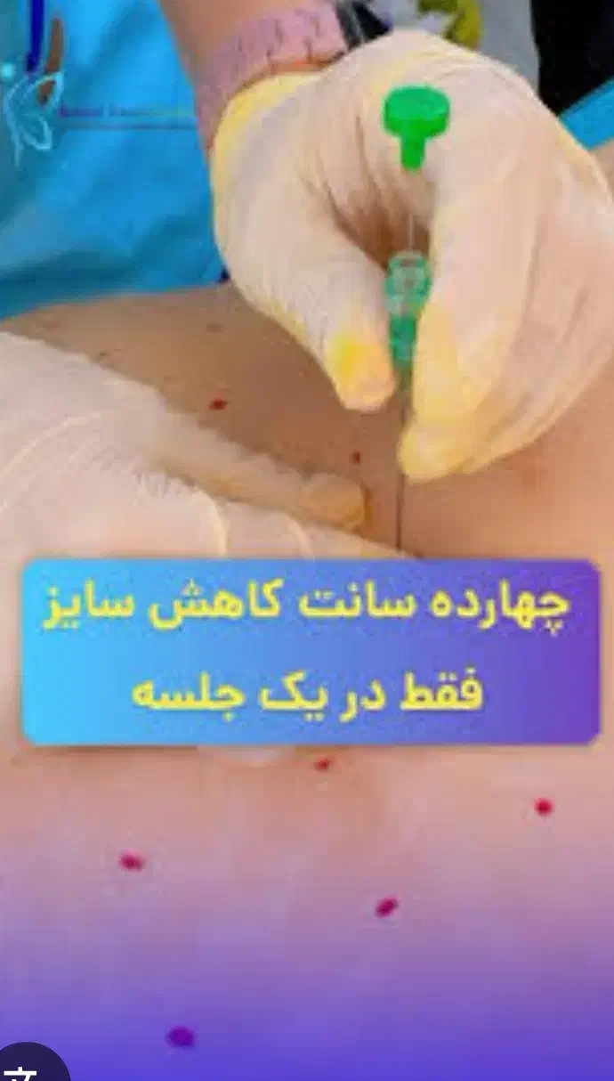 متد جدید لاغری با نخ های قابل جذب در مطب دکتر|خدمات آرایشگری و زیبایی|پاکدشت, پاکدشت (مامازند)|دیوار