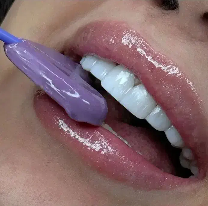 کامپوزیت دندان فکی ۸ میلیون با ضمانت ده ساله|خدمات آرایشگری و زیبایی|قزوین, |دیوار