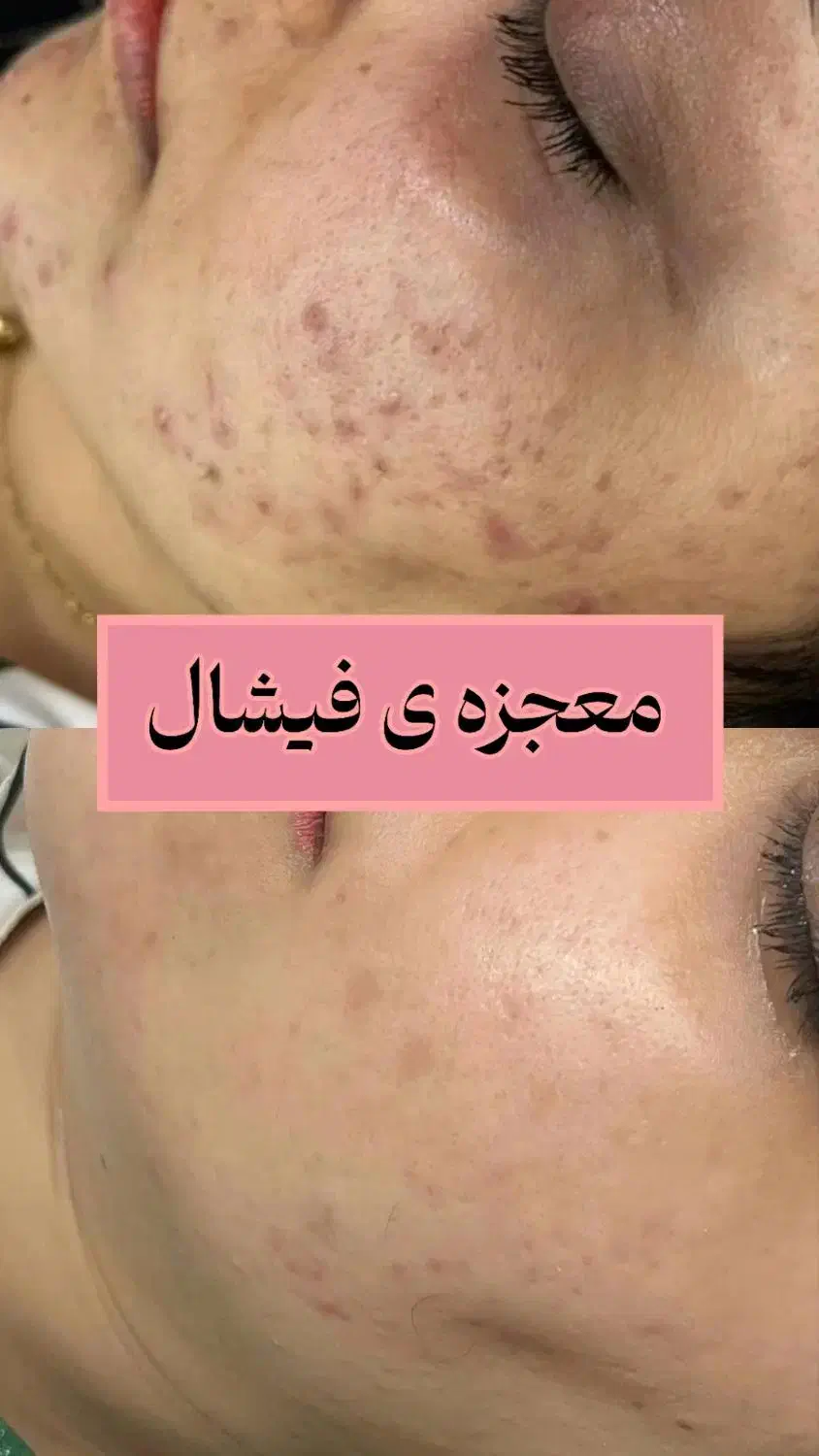آموزش فیشیال پاکسازی پوست تخفیف بلک فرایدی|خدمات آموزشی|کرمانشاه, |دیوار