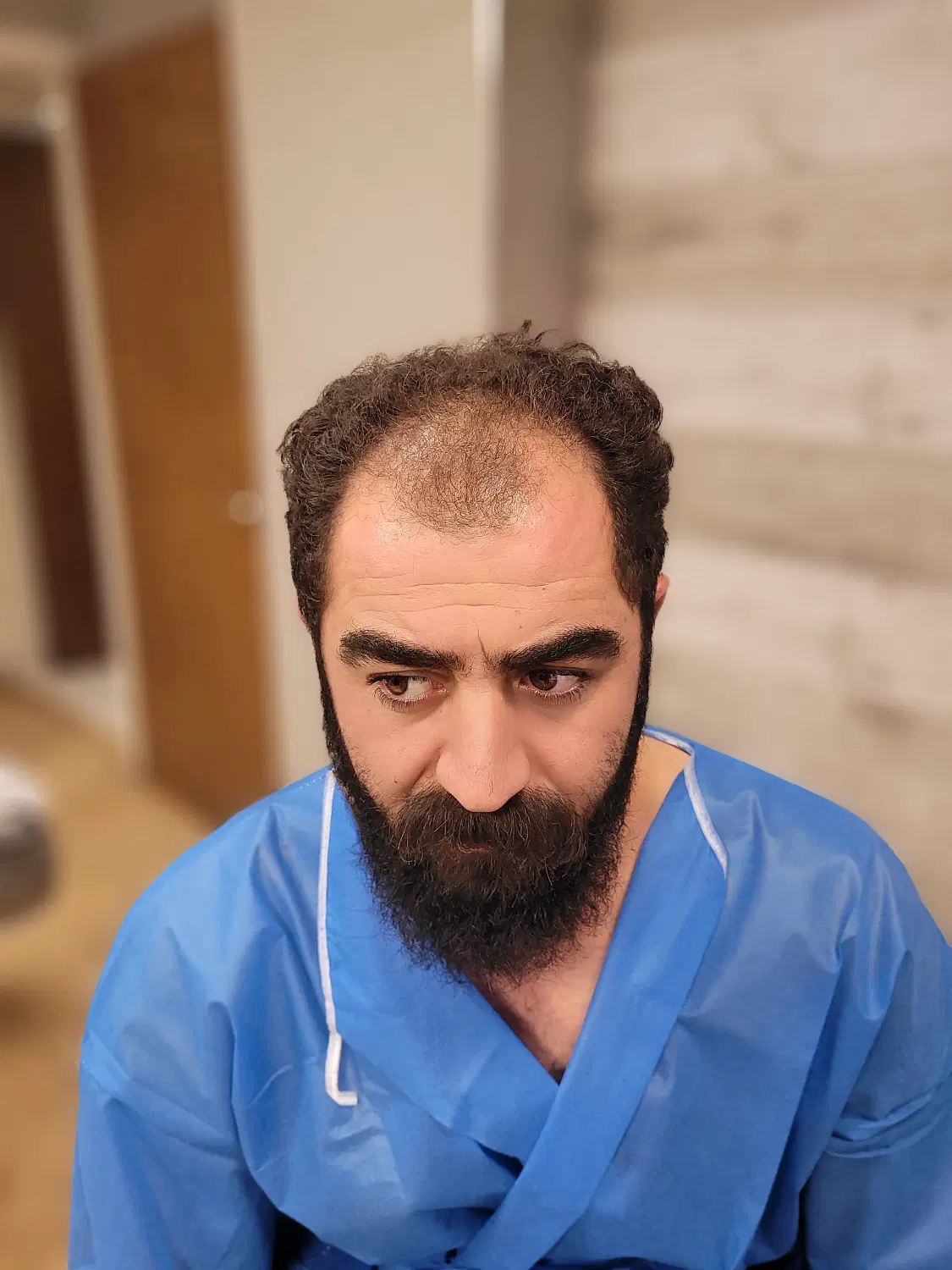 ضخیم شدن موی کاشته شده بامتدجدیدPRP|خدمات زیبایی و سلامت|تبریز, |دیوار
