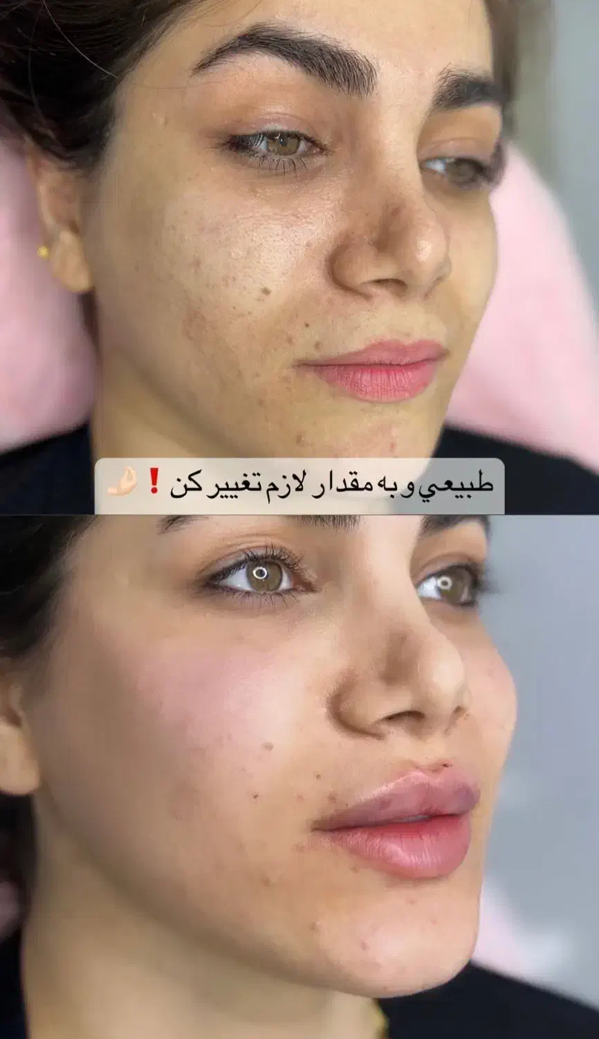 فیلر بادی ،تزریق ژل و بوتاکس با بهترین متریال قیمت|خدمات آرایشگری و زیبایی|دزفول, |دیوار