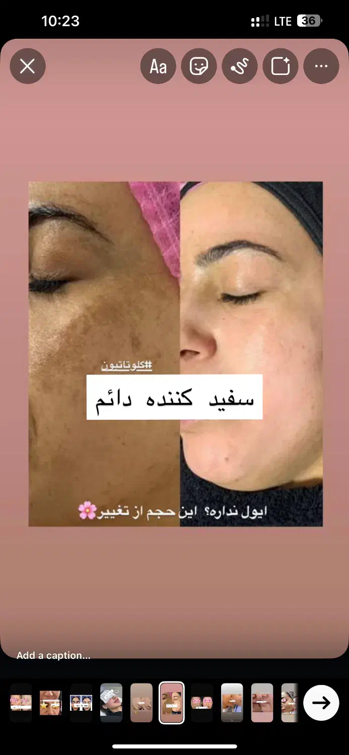 گلوتاتیون/درمان پیسی/روشن کننده کل صورت وبدن|خدمات آرایشگری و زیبایی|اهواز, کیانپارس |دیوار