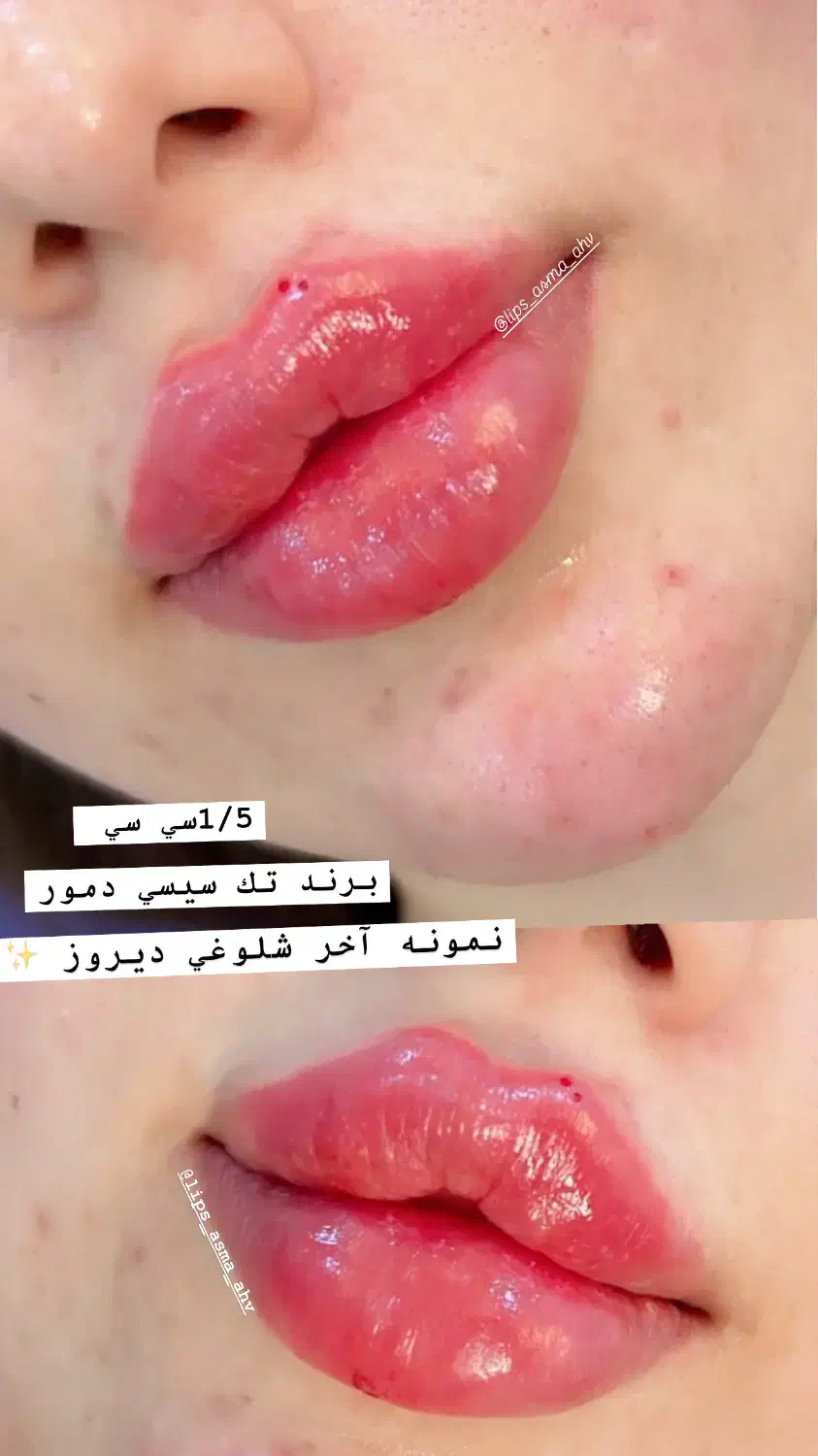 ژل وبوتاکس|خدمات آرایشگری و زیبایی|اهواز, کمپلو شمالی|دیوار