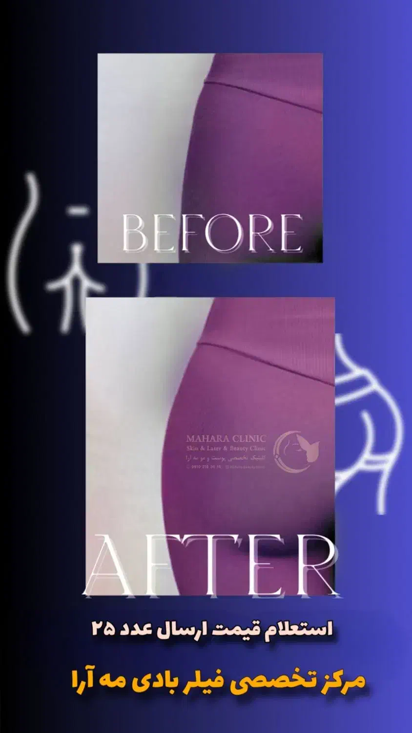 آف ۵۰٪ فیلر بادی هیپ دیپ سینه بیکینی باسن دست پا|خدمات آرایشگری و زیبایی|مشهد, نیروی هوایی|دیوار