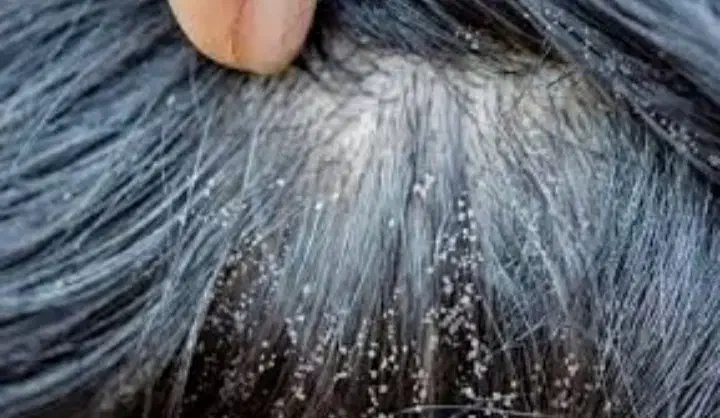 مایع رفع شپش مو|آرایشی، بهداشتی، درمانی|کرج, شهر صنعتی|دیوار