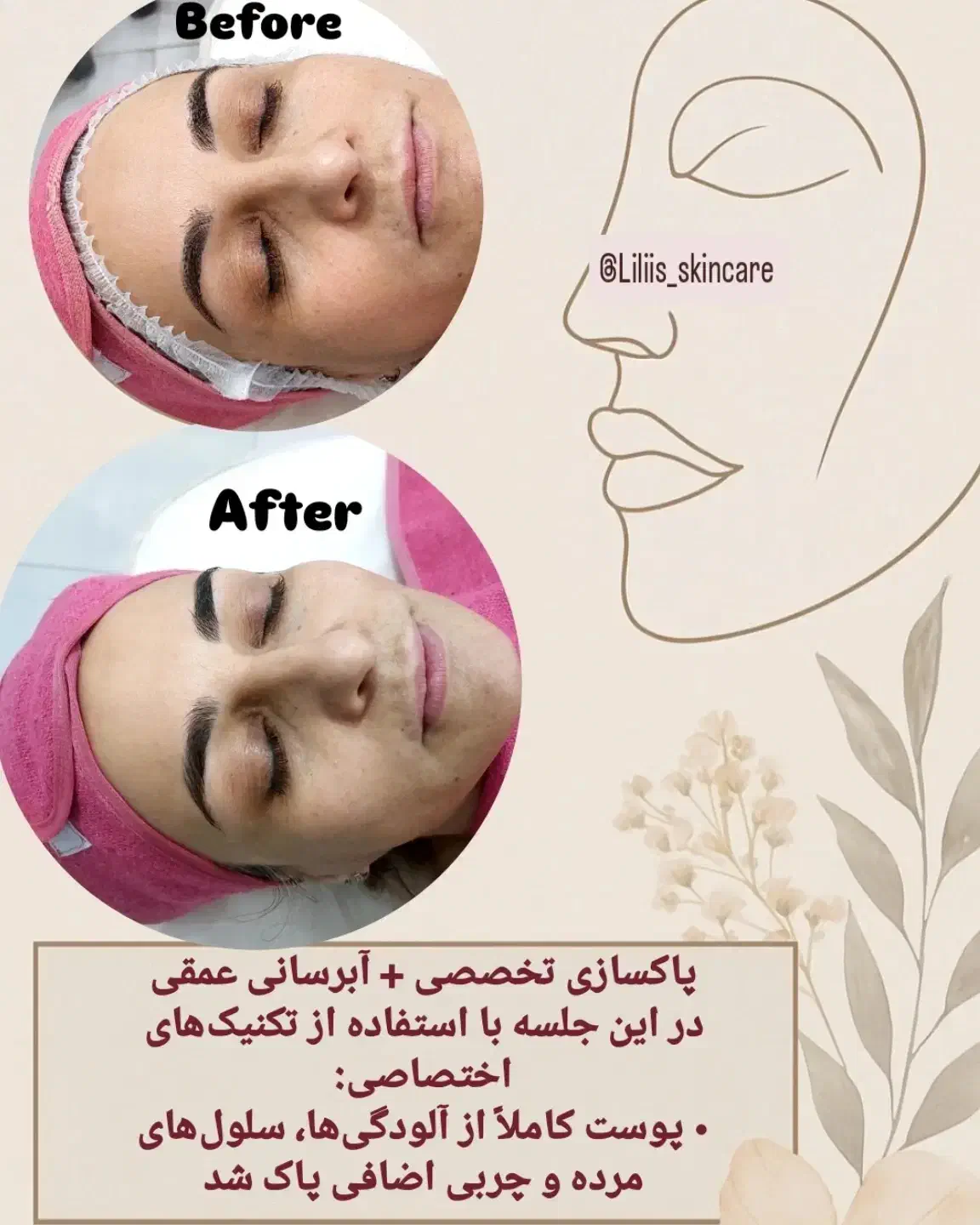 فیشیال و پاکسازی پوست|خدمات آرایشگری و زیبایی|اهواز, رسالت|دیوار