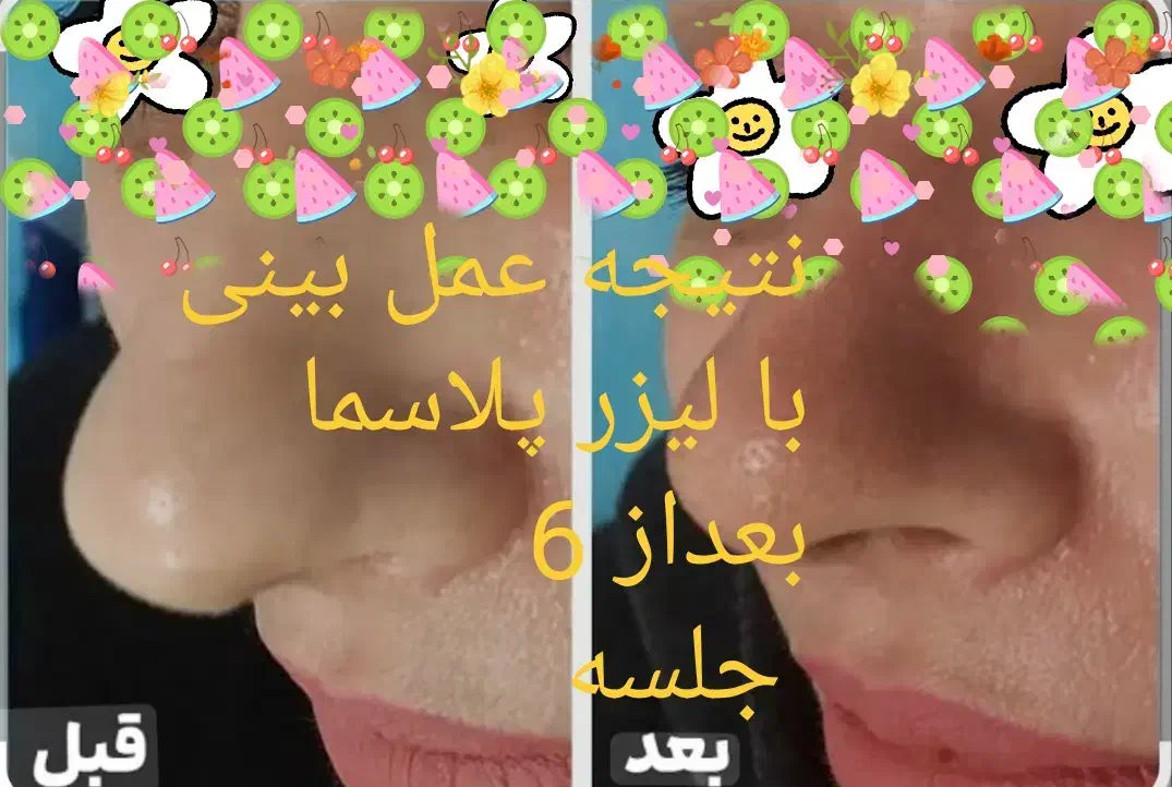 لیزرمیکرو پلاسمالیفت زیبایی/ بینی شیک/بلفاروپلاستی|خدمات آرایشگری و زیبایی|کرمانشاه, |دیوار