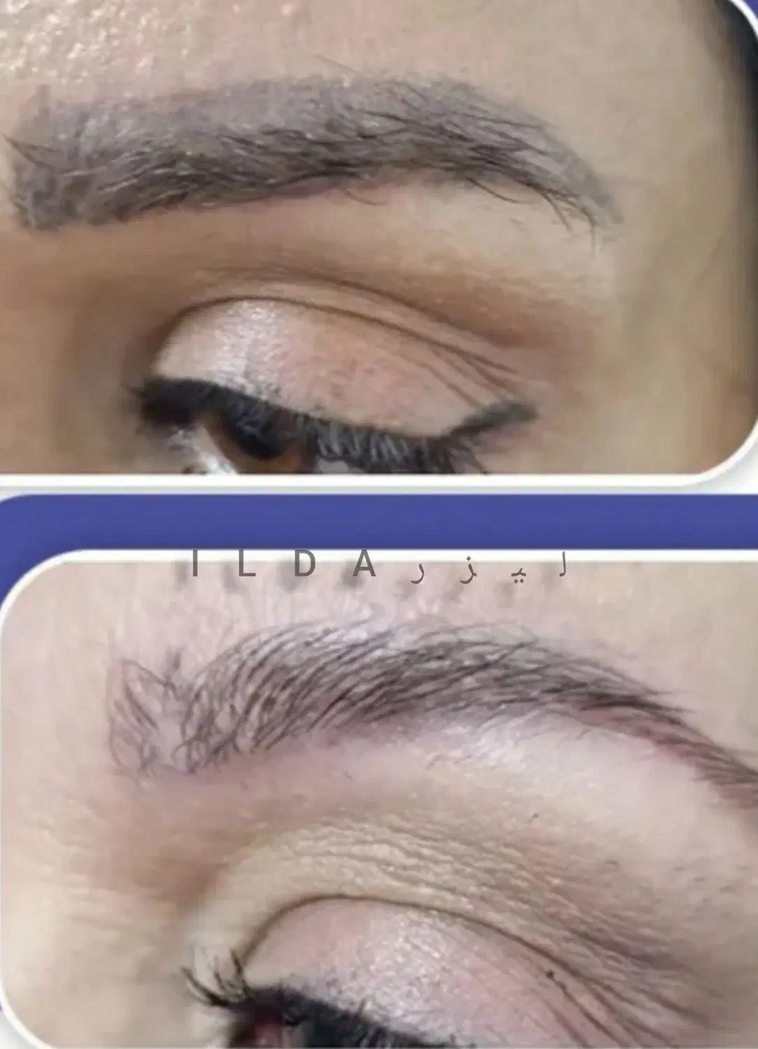 حذف تاتو و خالکوبی با لیزر کیوسوئیچ|خدمات آرایشگری و زیبایی|محمدشهر, محمدشهر|دیوار