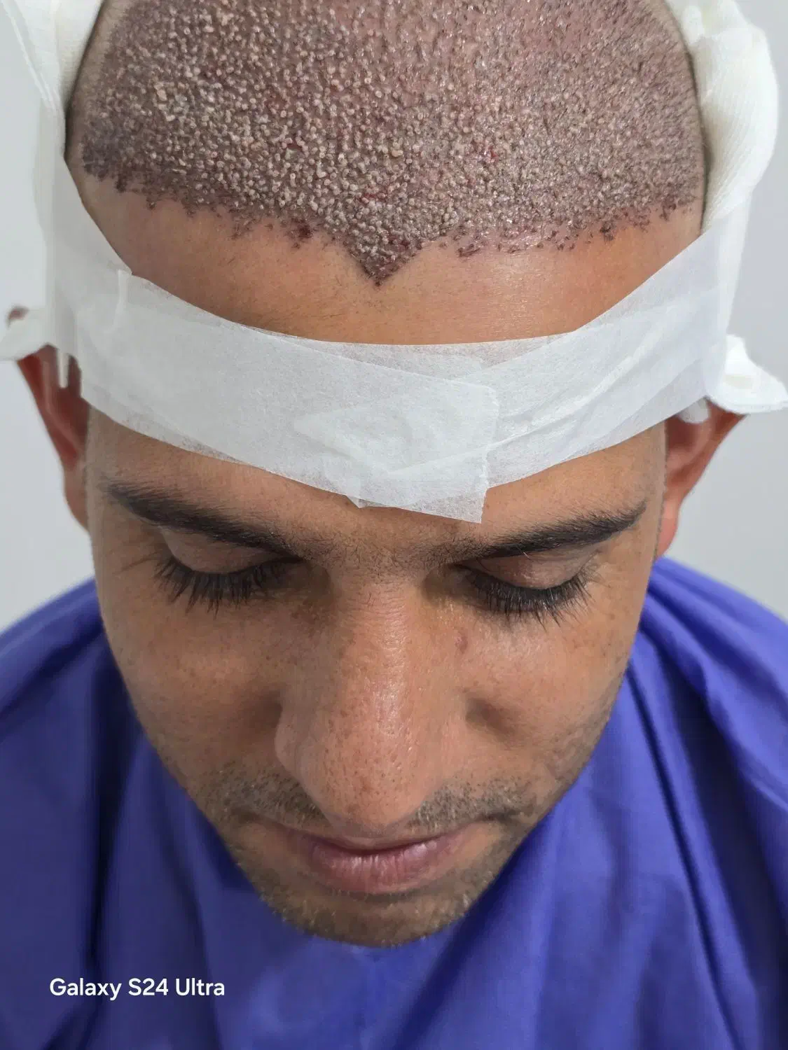 مرکز تخصصی کاشت موی طبیعی رویش طلایی مکران|خدمات آرایشگری و زیبایی|چابهار, |دیوار