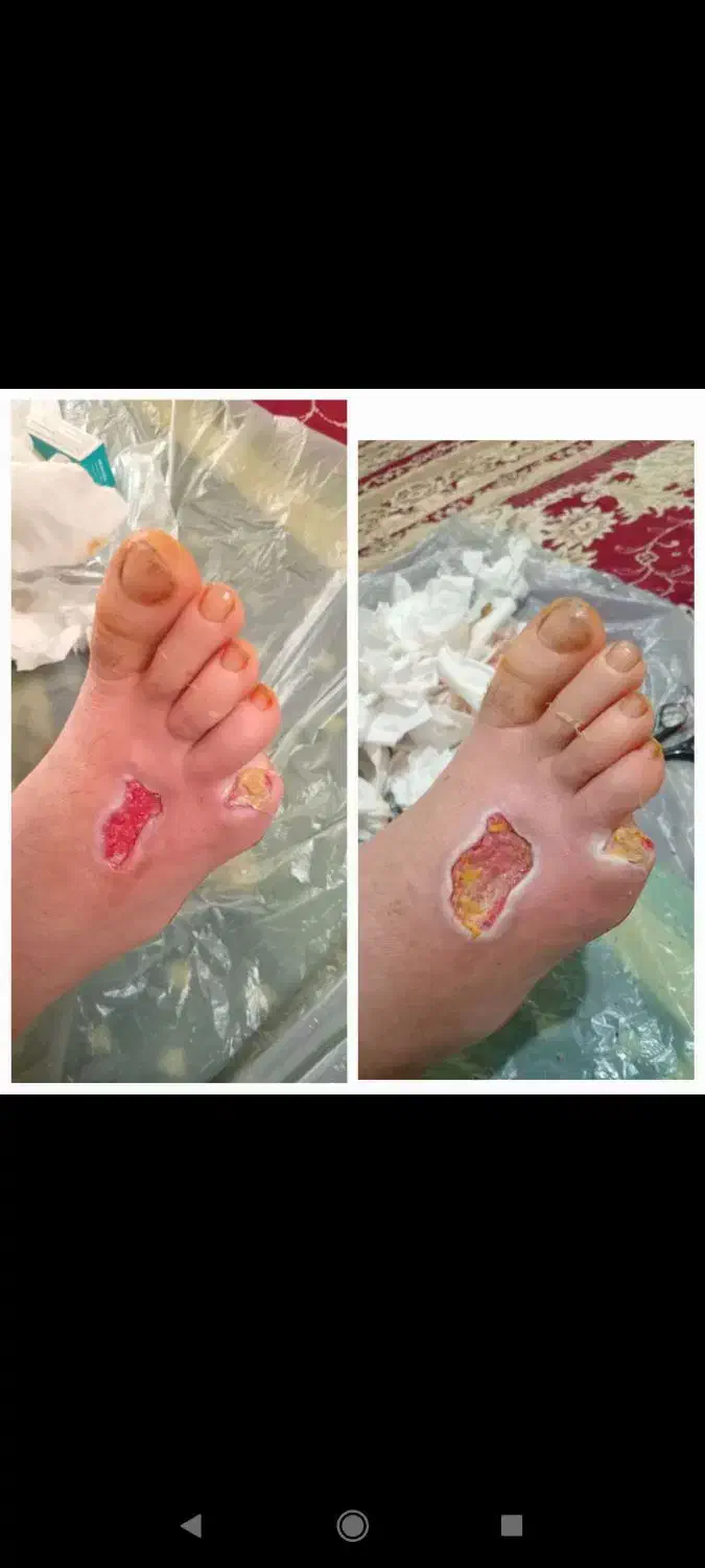 درمان زخم دیابت و زخم بستر سوختگی و عفونی|خدمات آرایشگری و زیبایی|کرج, باغستان|دیوار