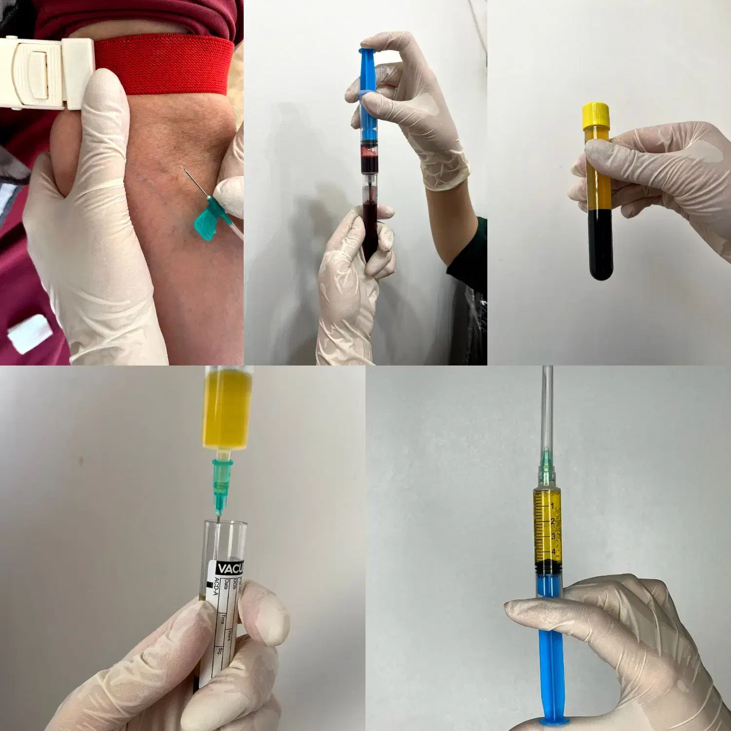 تخفیف ویژه پی آر پی|آرایشی، بهداشتی، درمانی|بهبهان, |دیوار