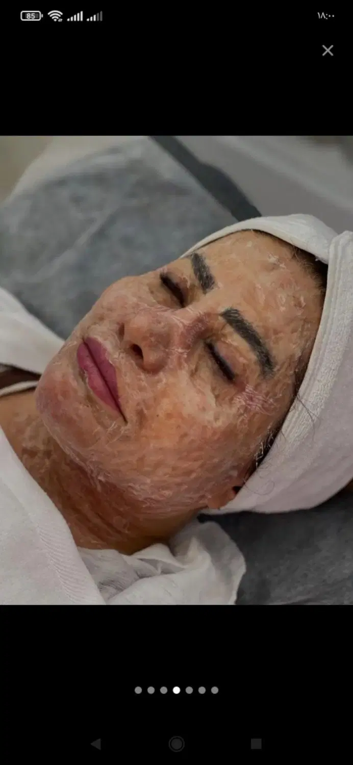فشیال کامل پوست همراه با وکس صورت رایگان|خدمات زیبایی و سلامت|تهران, امیر بهادر|دیوار