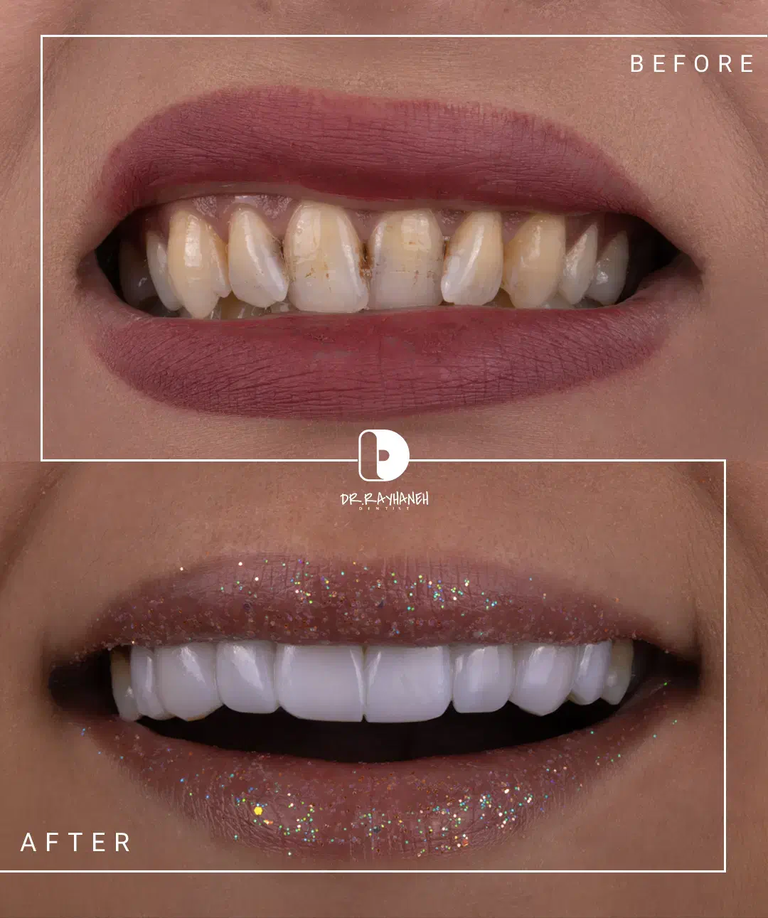 کامپوزیت دندان/لمینیت/دندانپزشکی|خدمات آرایشگری و زیبایی|مشهد, کوثر|دیوار