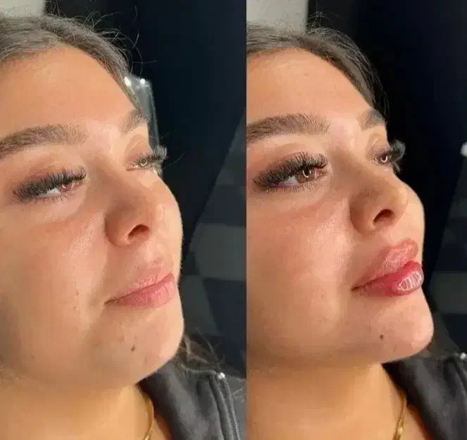 مزونیدلینگ ژل و بوتاکس|خدمات آرایشگری و زیبایی|یاسوج, |دیوار