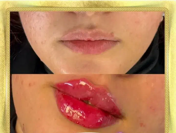 جشنواره آموزش ژل بوتاکس کمترین هزینه هفده شهریور|خدمات آموزشی|تبریز, |دیوار