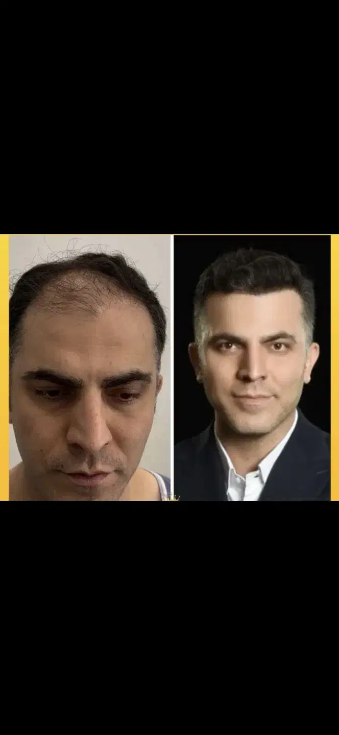 کاشت مو فقط 6 میلیون تومان به مدت محدود|خدمات آرایشگری و زیبایی|شیراز, زرگری|دیوار