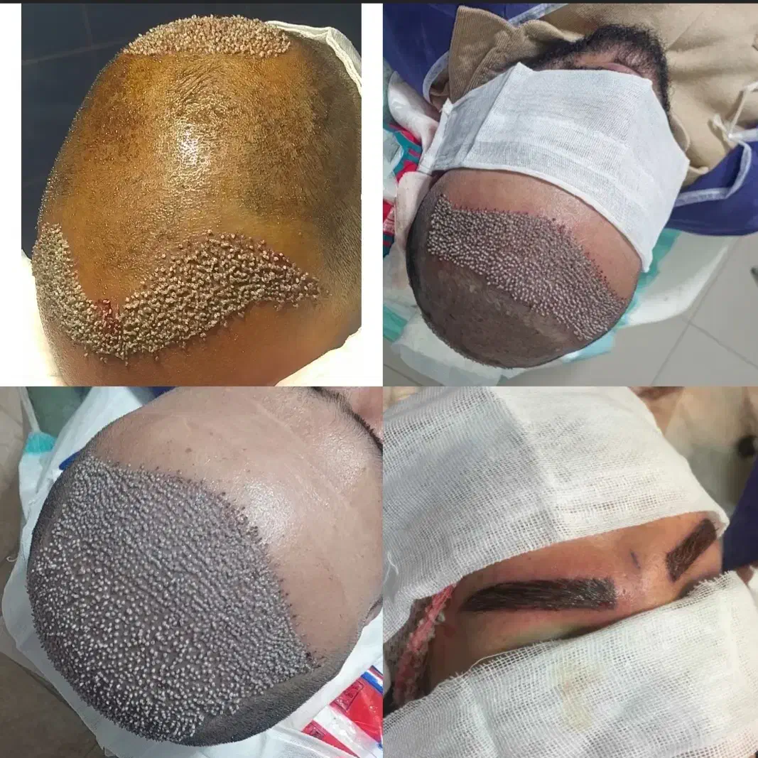 کاشت مو و کاشت ابرو، میکروگرافت|خدمات آرایشگری و زیبایی|کرمانشاه, |دیوار