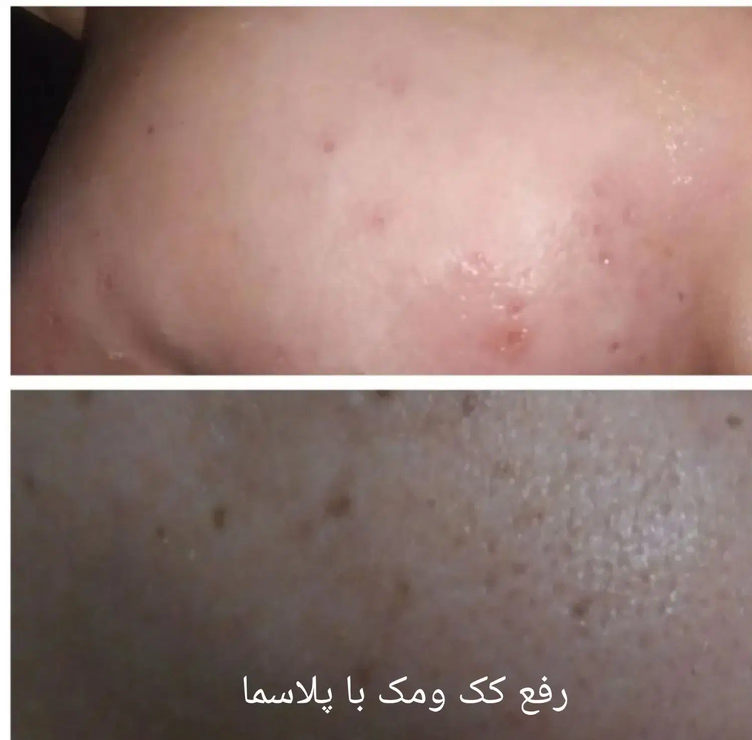 مزونیدلینگ کل صورت و پاکسازی وخالبرداری وآموزش|خدمات آرایشگری و زیبایی|یزد, |دیوار