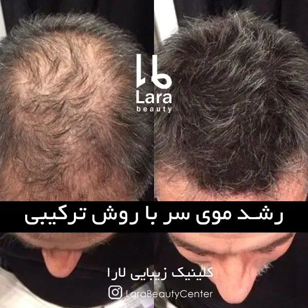 پی آر پیPRP درمان ریزش مو مزوتراپی هیرفیلر کاشت مو|خدمات آرایشگری و زیبایی|تهران, صادقیه|دیوار