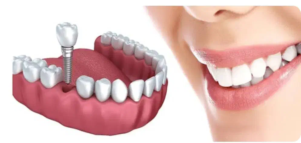 ایمپلنت با کیفیت و تعرفه دولتی|خدمات آرایشگری و زیبایی|رشت, دیلمان|دیوار