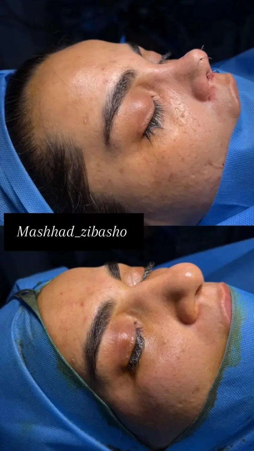 عمل بینی لیپو ساکشن ابدو غبغب بلفارو لیفت سانترال|خدمات زیبایی و سلامت|مشهد, احمدآباد|دیوار