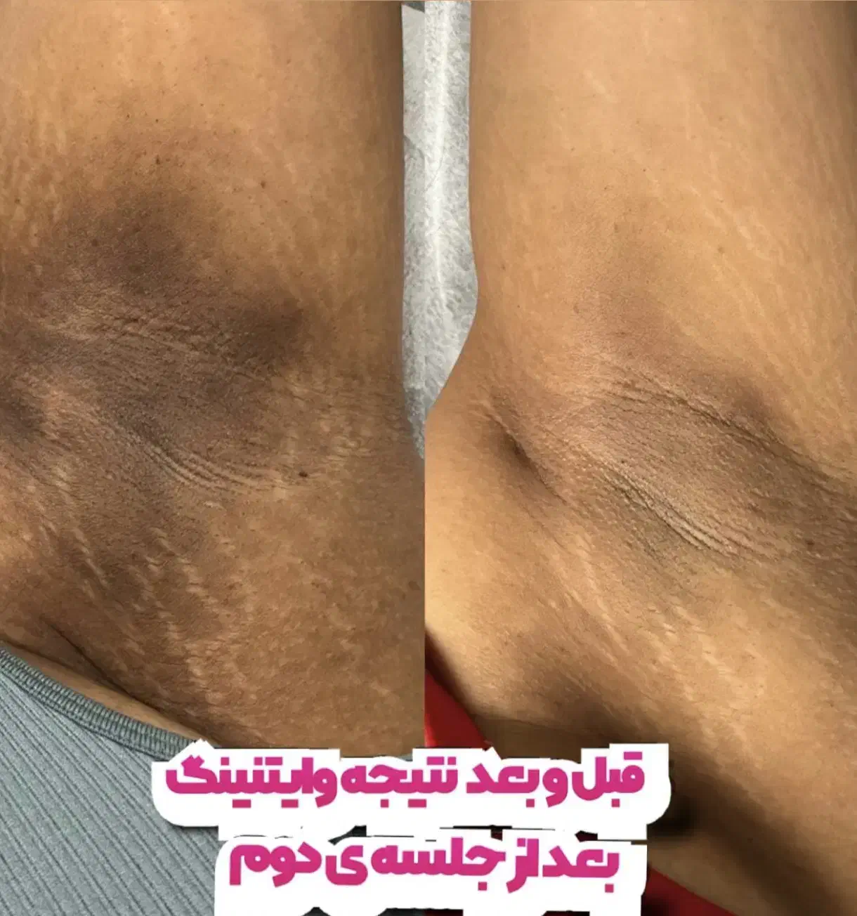 بلک فرایدی وایتنینگ تخصصی بیکینی زیربغل زانو|خدمات آرایشگری و زیبایی|رشت, رودباری|دیوار