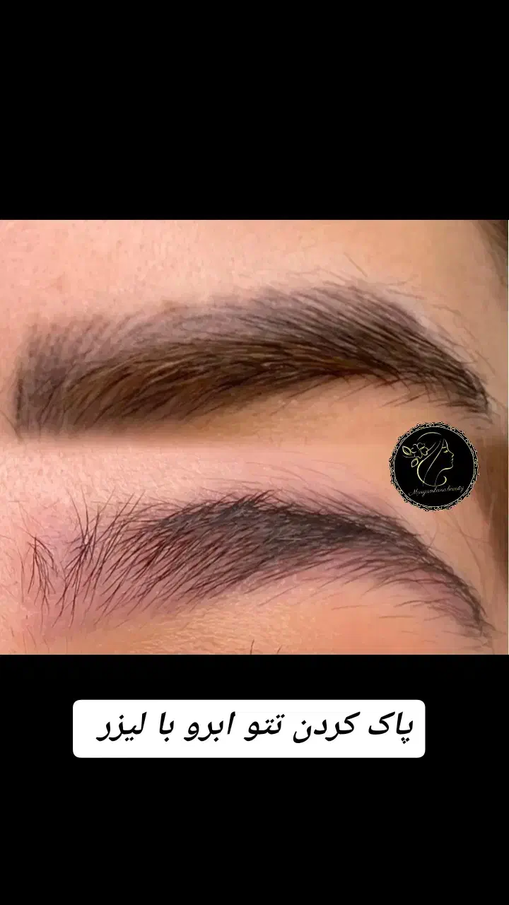 متخصص پاک کردن ریموو تتو ابرو با لیزر|خدمات آرایشگری و زیبایی|مشهد, آزادشهر|دیوار