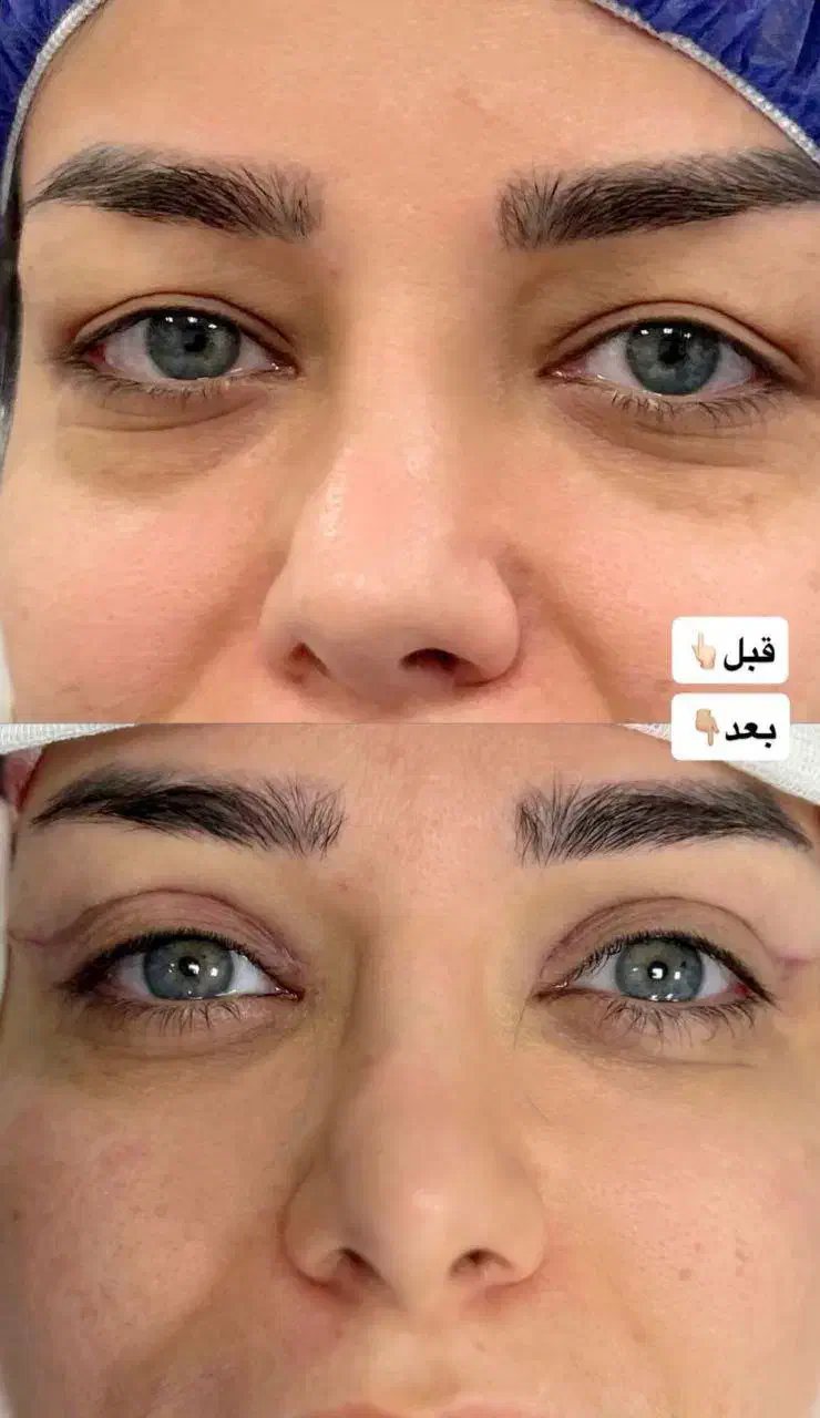 جشنواره پاییزه جراحی زیبایی پلک(بلفاروپلاستی)|خدمات آرایشگری و زیبایی|تهران, قیطریه|دیوار
