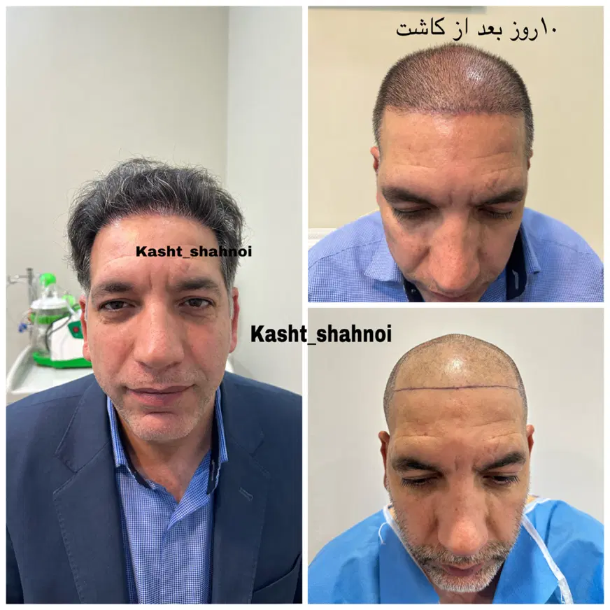 کاشت تخصصی مو و ابرو|خدمات زیبایی و سلامت|مشهد, ملکآباد|دیوار