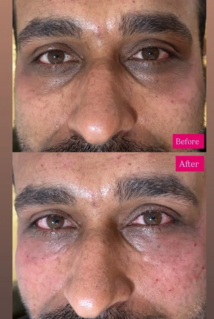 تزریق پی ار پی،مزو مزوژل(تخفیفات افتتاحیه)|خدمات زیبایی و سلامت|شیراز, چوگیاه|دیوار