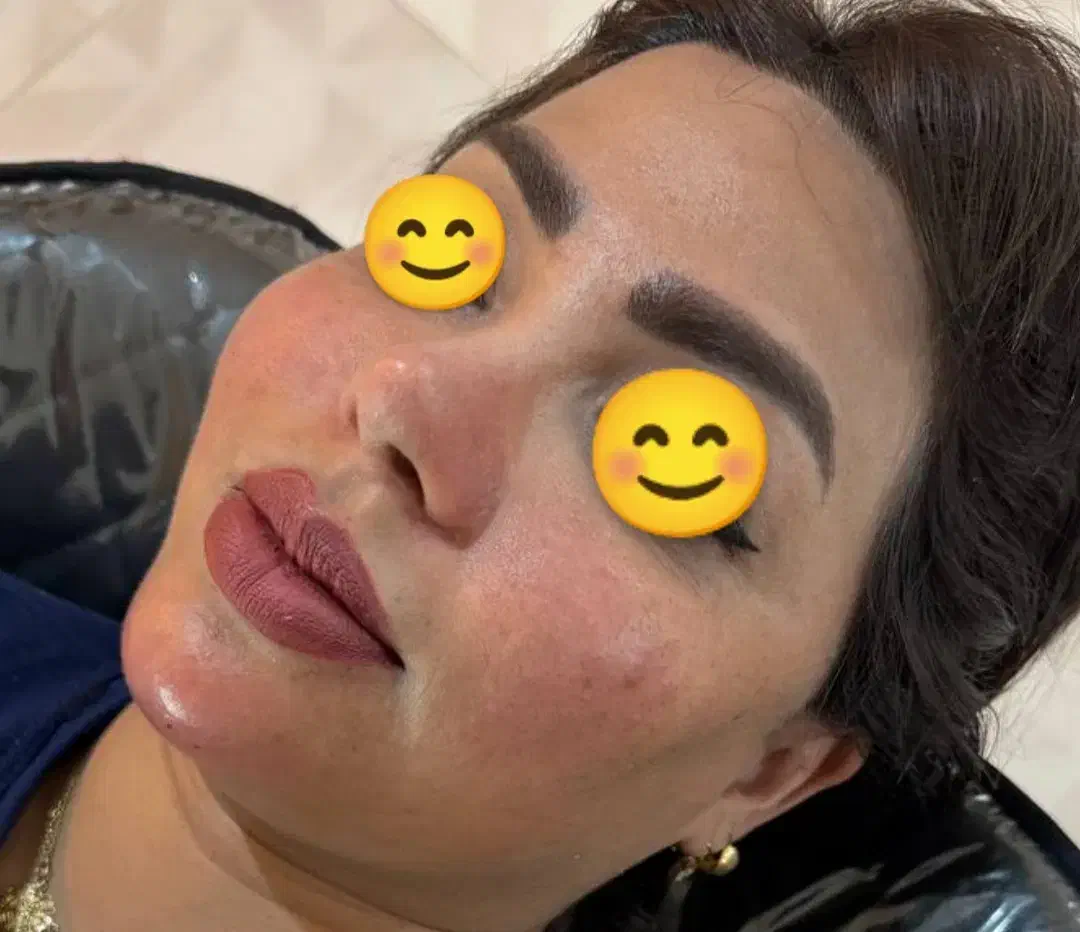 ژل و بوتاکس مزوتراپی و مزونیدلینگ آرایش دایم|خدمات آرایشگری و زیبایی|اردکان, |دیوار