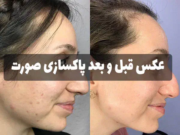 آف پاکسازی پوست صورت|خدمات آرایشگری و زیبایی|مسجد سلیمان, |دیوار