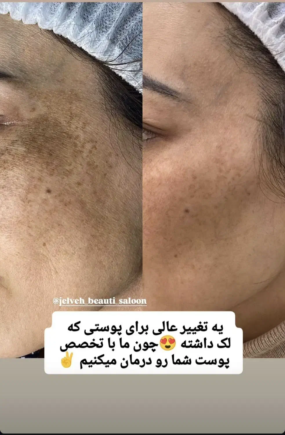 آموزش درمان لک وتیرگی با آلگاپیل فقط با پانصدهزار|خدمات آموزشی|همدان, |دیوار