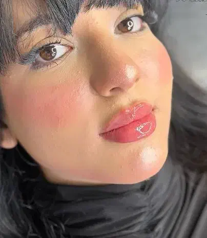 ژل بوتاکس پی ار پی توسط پزشک|خدمات آرایشگری و زیبایی|شاهین‌شهر, فردوسی|دیوار