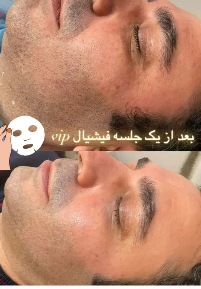 فیشیال صورت آقایان وخانم ها مطب دکتر پروین گودرزی|خدمات آرایشگری و زیبایی|یاسوج, |دیوار