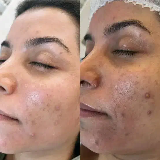 آموزش فشیال و درمان پوست (تخصصی پزشکی)|خدمات آموزشی|اردبیل, |دیوار