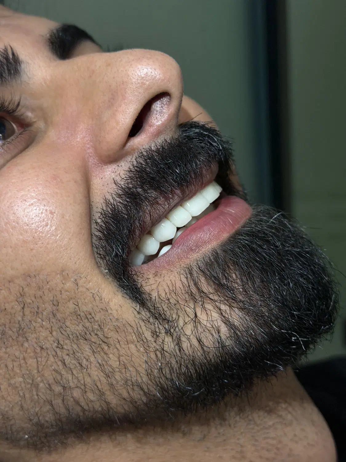کامپوزیت/اقساط/لمینت/عصبکشی|خدمات زیبایی و سلامت|تهران, سازمان برنامه شمالی|دیوار