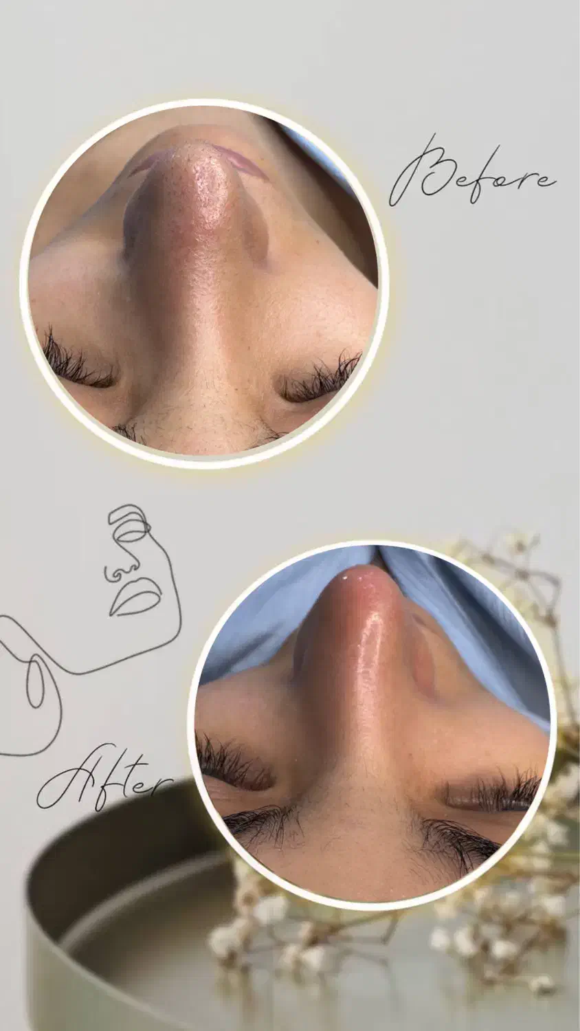 تخفیف فیشیال کلاسیک(رفع جوش سرسیاه)|خدمات آرایشگری و زیبایی|دوگنبدان, |دیوار