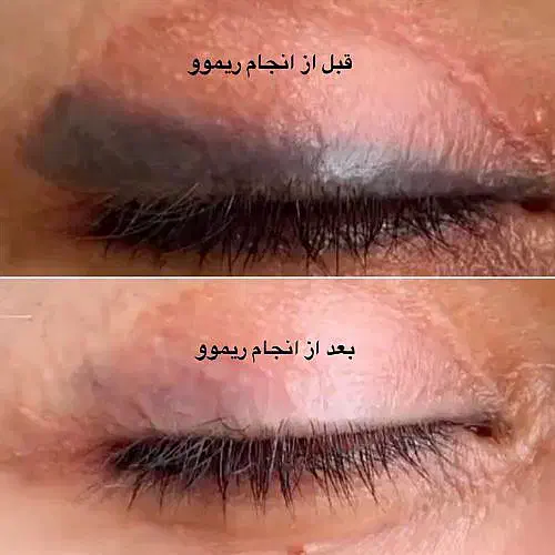 ریموو ریمو پاک کردن تتو تاتو پاک کردن|خدمات آرایشگری و زیبایی|شاهینشهر, عطار|دیوار